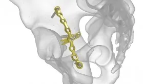 Pelvic Plating System Orthopaedic Solutions Fixation Products – Care ...